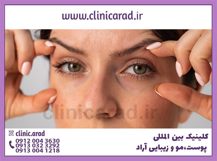عکس خانمی که می خواهد روش برداشتن پف چشم با بلفاروپلاستی رو انجام دهد برای زیبایی چشم ها