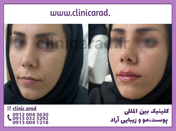 نمونه کار واقعی تزریق ژل لب در کلینیک بین المللی پوست مو زیبایی آراد اصفهان 
