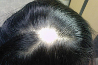 علت ریزش موی سکه ای و درمان آن
