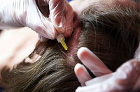درمان قطعی ریزش موی سکه ای چیست؟