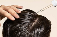 درمان ریزش مو از ریشه