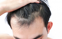 تجربه درمان ریزش مو ارثی چیست؟
