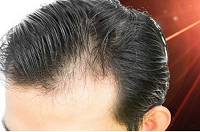 بهترین درمان ریزش موی ارثی