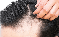 جلوگیری از ریزش موی ارثی و ژنتیکی
