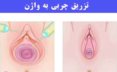 جوانسازی واژن با تزریق چربی