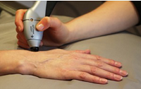جوانسازی پوست دست با لیزر 1