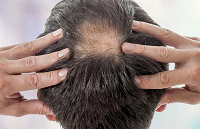 درمان ریزش مو ها با قرص فینا استراید