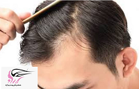 درمان ریزش مو با الگوی مردانه