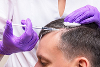 درمان ریزش موی ارثی با پی آر پی