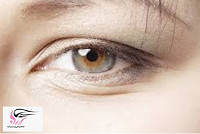 درمان از بین بردن پف بالای چشم