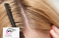 درمان و جلوگیری از ریزش مو