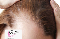 عوامل اصلی ریزش مو در زنان