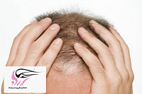 درمان کم پشتی موی سر