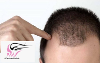 درمان ریزش موی مردان با طب سنتی