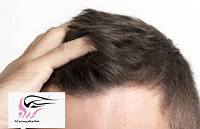 انواع روش درمانی ریزش مو در مردان