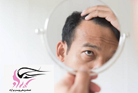 علت ریزش شدید مو ها چیست؟