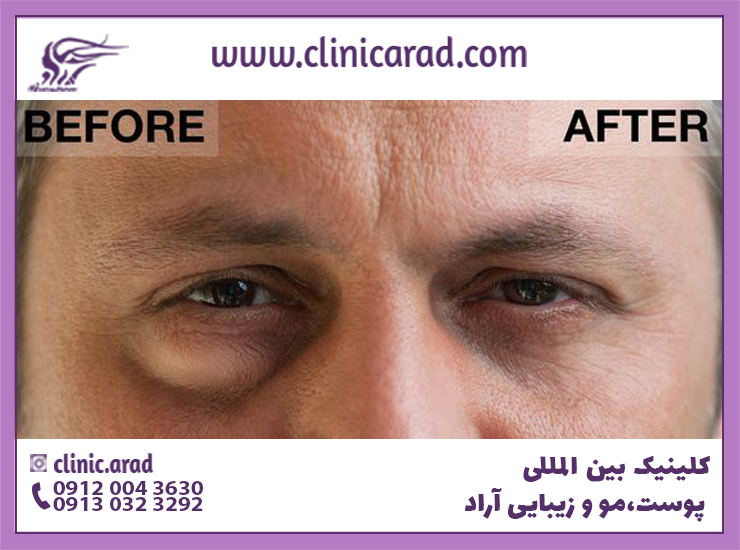 عکس قبل و بعد جراحی پف زیر چشم مردان