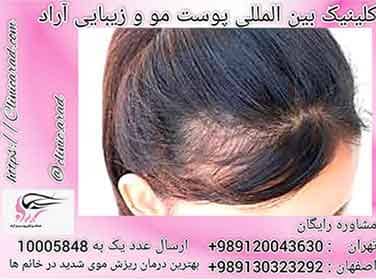درمان ریزش موی ارثی در خانم ها