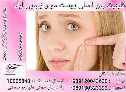 راه درمان جوش زیر پوستی صورت