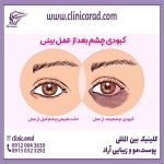 تورم و پف چشم بعد از عمل بینی