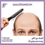 بهترین روش کاشت مو در تهران توسط دکتر علیزاده تضمینی