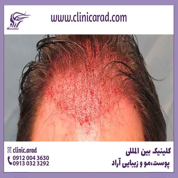 درمان قرمزی پوست سر بعد از کاشت مو