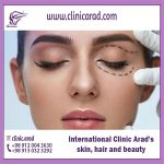 In what cases is Blepharoplasty performed?