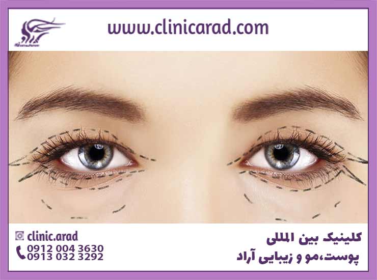 درمان افتادگی پلک با لیزر در اصفهان