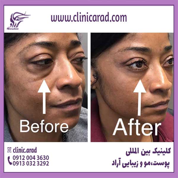 تصاویر قبل و بعد از جراحی بلفاروپلاستی پلک پایین
