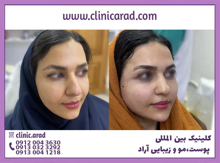 عکس قبل و بعد از تزریق چربی به صورت دختر در کلینیک